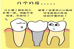 种牙的费用多少钱，种植牙的具体过程有哪些？