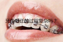 牙齿矫正的过程复杂吗？