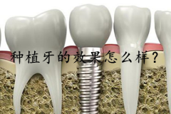 种植牙的效果怎么样？为什么会有许多人选择种
