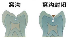 儿童窝沟封闭是怎么一回事儿？