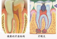 牙髓炎怎么治疗好？
