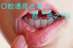 警惕顽固性的口腔溃疡，溃疡也有良、恶之分！