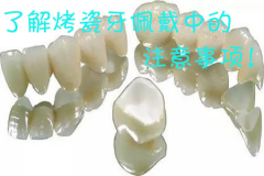 了解烤瓷牙佩戴过程中的注意事项！