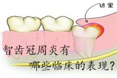 智齿冠周炎有哪些临床的表现？