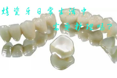 烤瓷牙日常生活中需要护理吗？