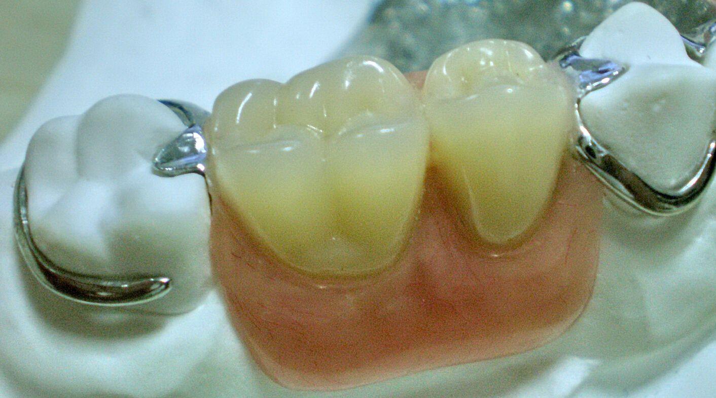 缺了颗牙建议做活动假牙吗？