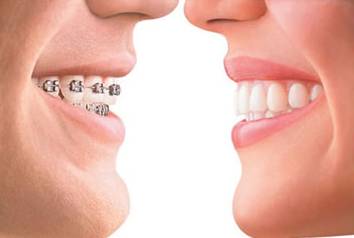 【福州】牙齿正畸 3 大误区，你了解吗？